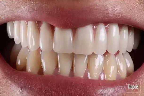 Depois do tratamento dental