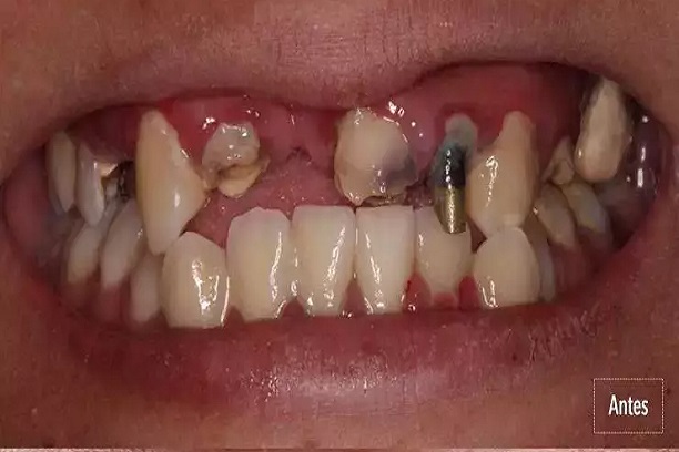 Antes do tratamento dental