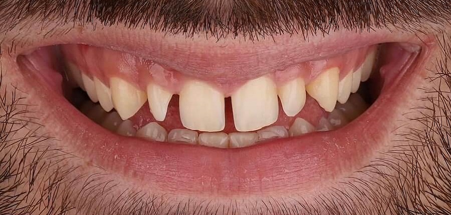 Sorriso transformado