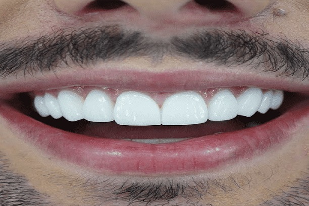 Depois do tratamento dental