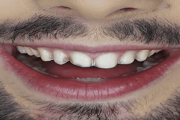 Antes do tratamento dental