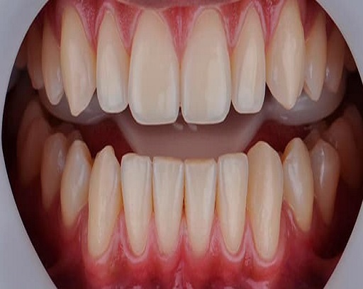 Antes do tratamento dental