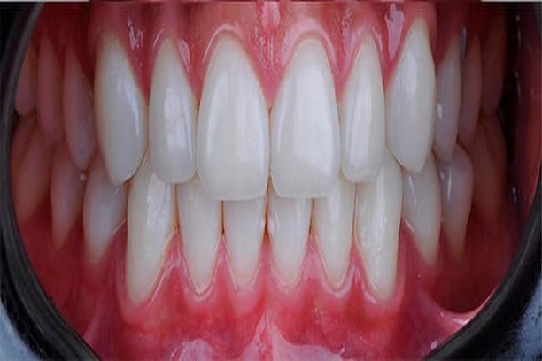 Depois do tratamento dental