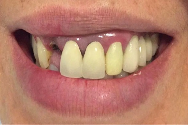 Antes do tratamento dental