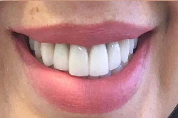 Depois do tratamento dental